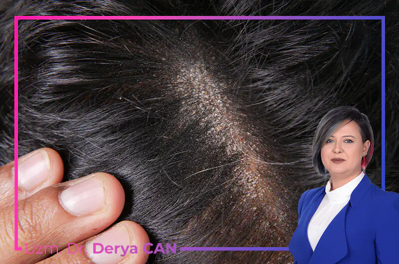 Seboreik Dermatit Tedavisi 2 Seboreik dermatit tedavisi yöntemleri