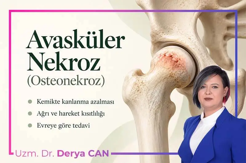 Kalça ekleminde avasküler nekrozu temsil eden, femur başındaki kemik hasarının vurgulandığı görsel.